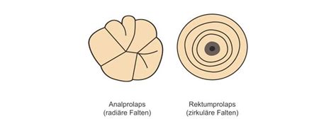 Analprolaps